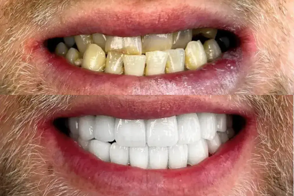 Ile licówek potrzebujesz? Od 1 zęba po Hollywood Smile!