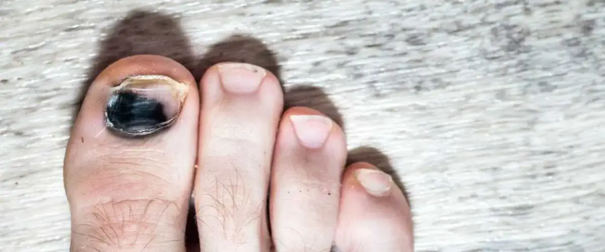 Jak skutecznie zmniejszyć ból krwiaka pod paznokciem i odzyskać komfort