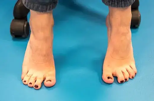 Jak pozbyć się haluksów domowym sposobem i ulżyć sobie w bólu