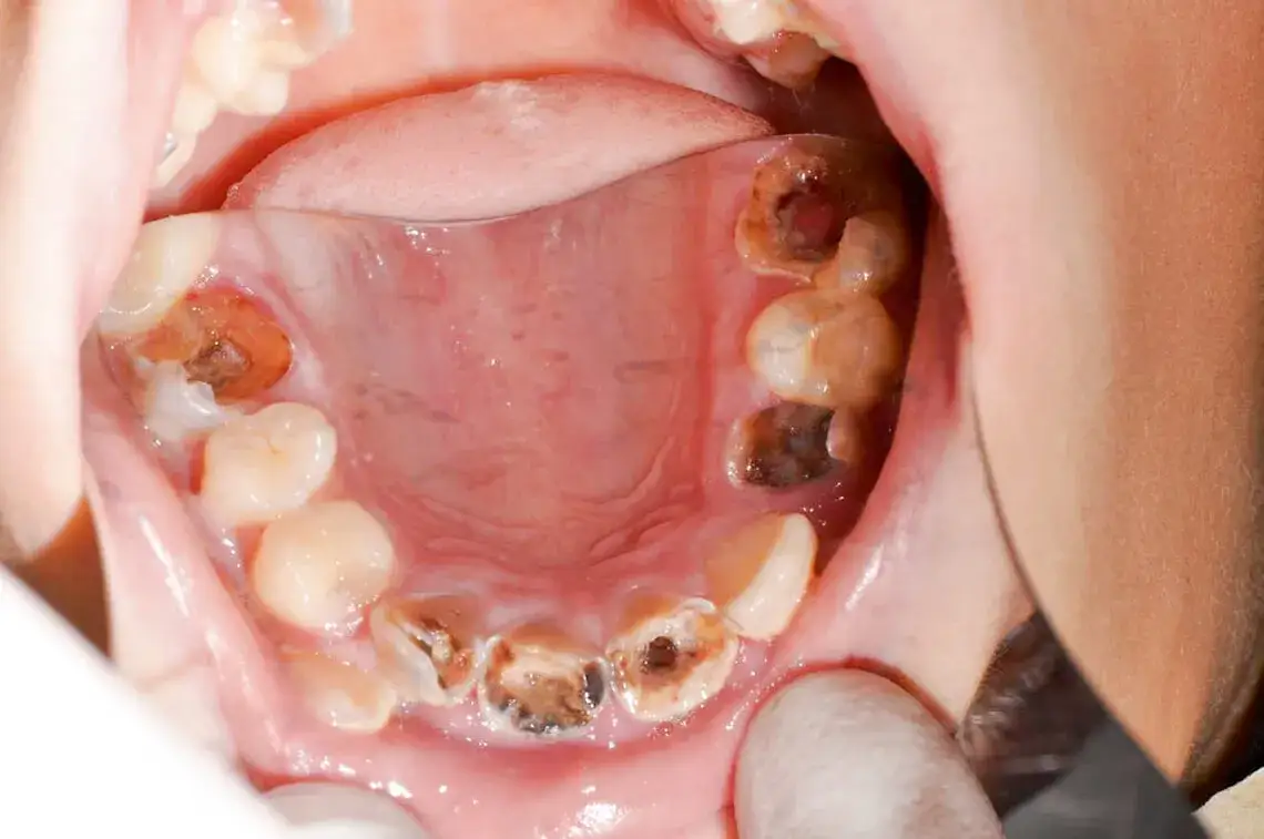 Otwarta przetoka po wyrwaniu zęba: objawy i leczenie