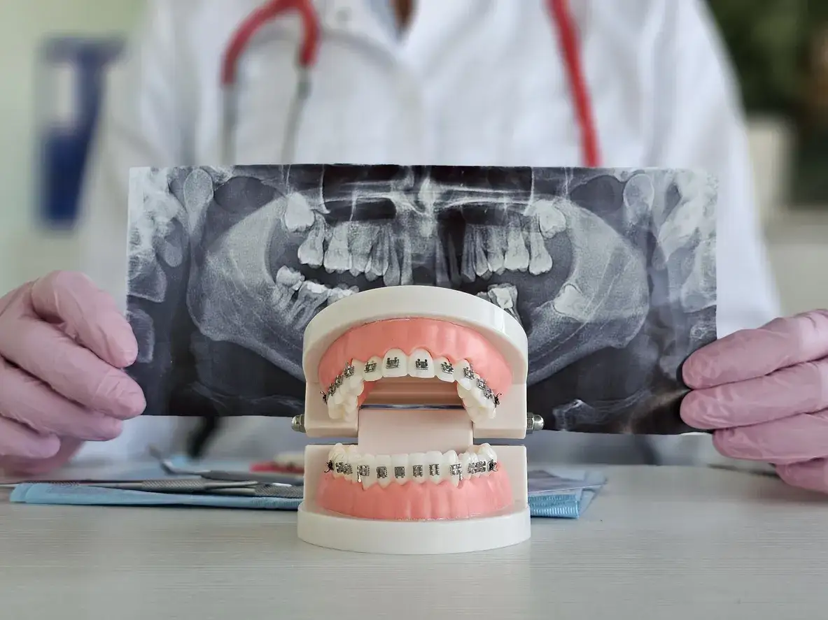 Kiedy założyć aparat na zęby? Nigdy nie jest za późno!