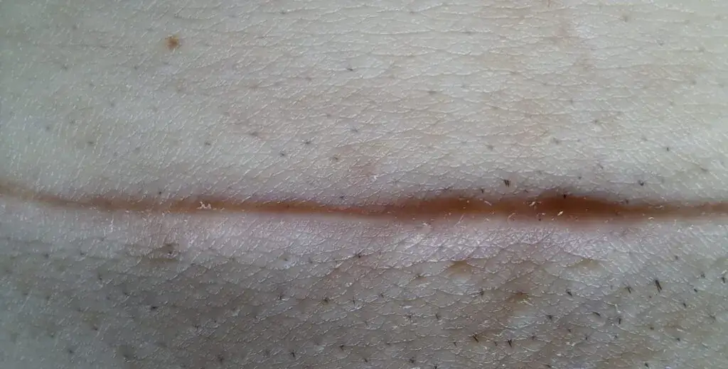 Kto ściąga szwy po porodzie? Dowiedz się, co warto wiedzieć o procesie.