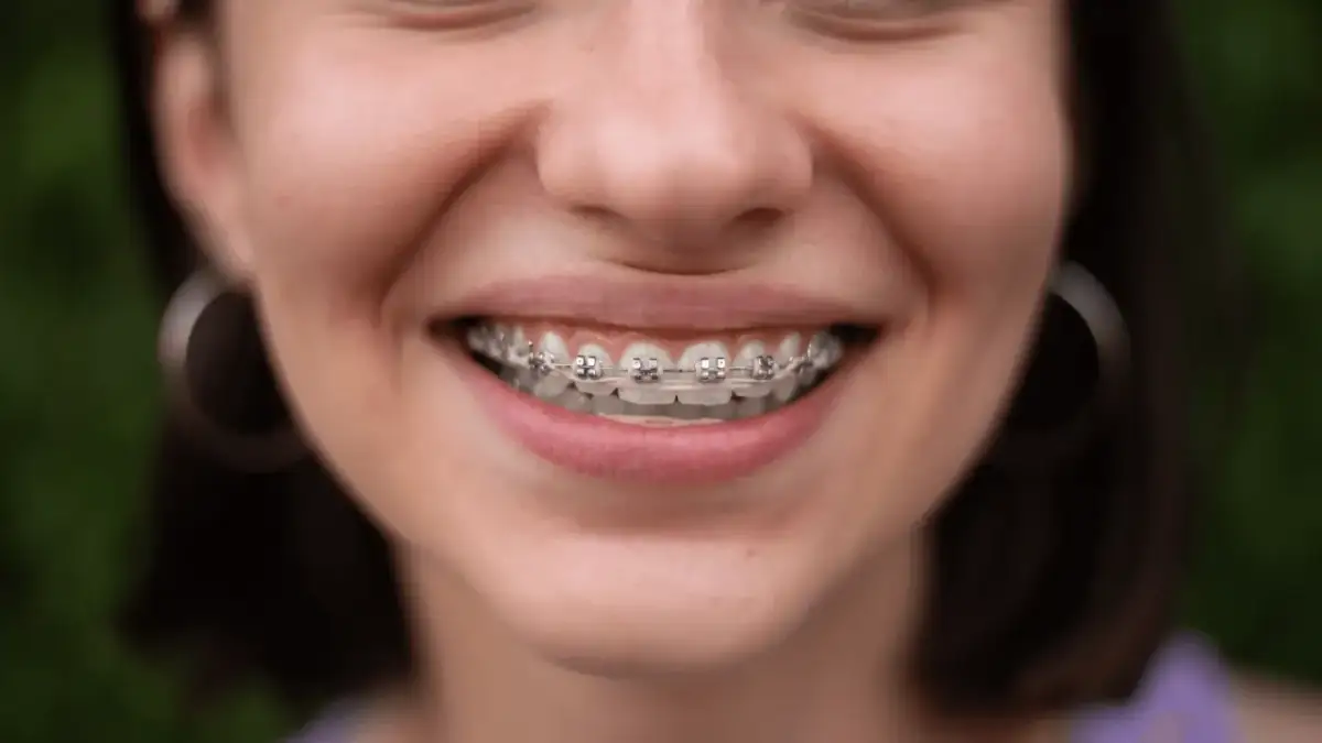 Jak działa aparat na zęby? Odkryj sekrety prostego uśmiechu!