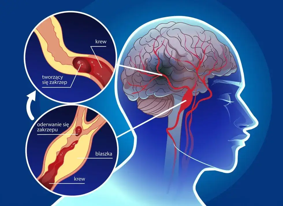 PFO objawy neurologiczne: Jak unikać ryzyka udaru mózgu?