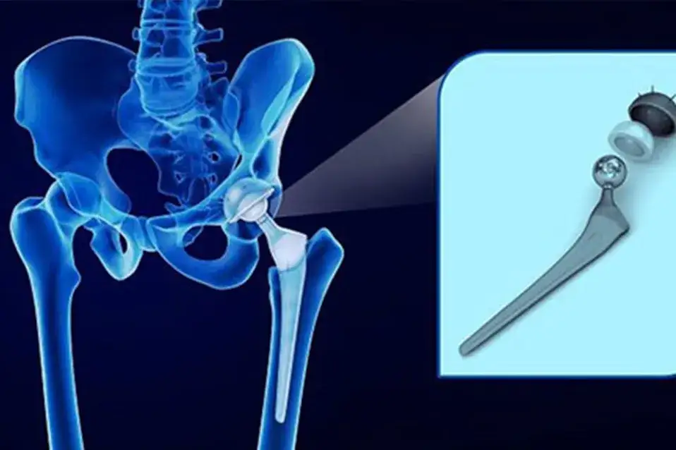 Jak długo trwa ból po endoprotezie? Sprawdź, co jest normalne