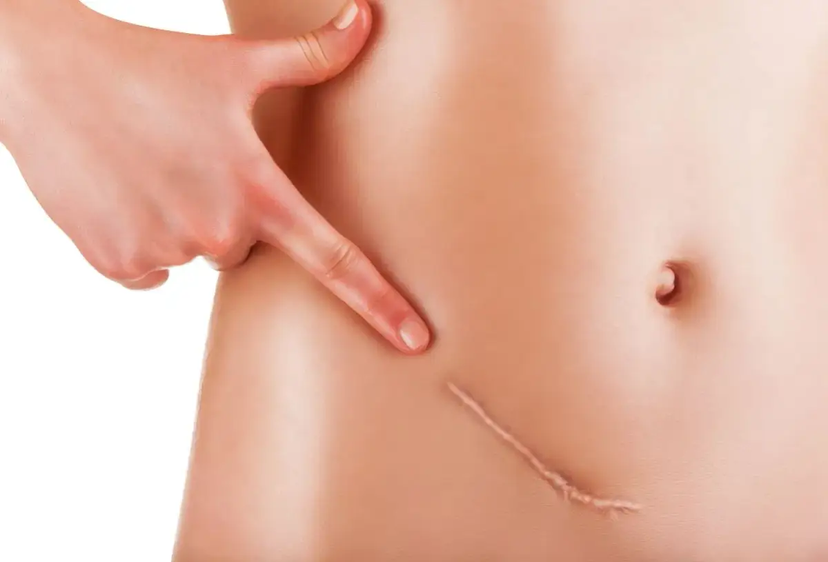 Strup po pryszczu? Skuteczne sposoby na szybkie gojenie bez blizn