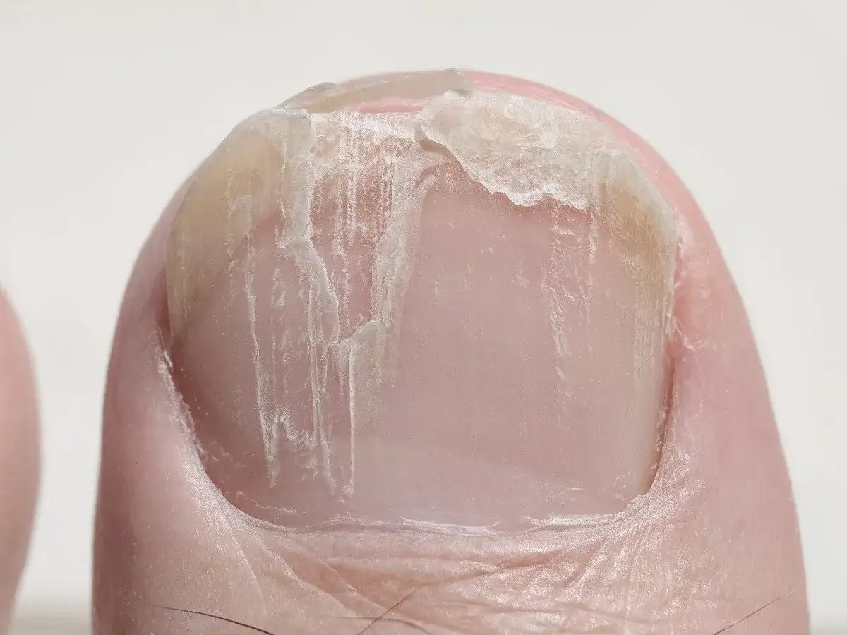 Pionowe bruzdy na paznokciach: Naturalny objaw czy choroba?