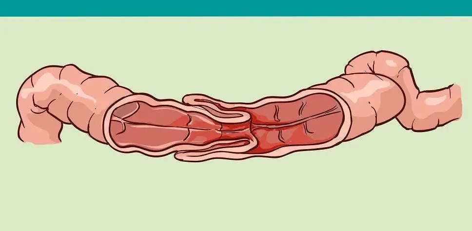 Wgłobienie jelita u niemowlaka objawy – jak je rozpoznać i reagować