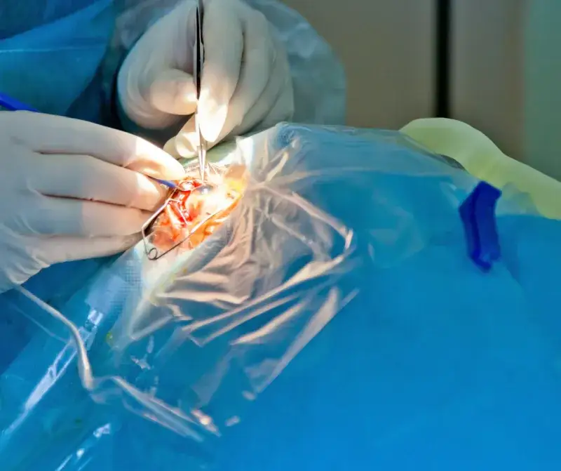 Jak długo trwa zabieg na zaćmę? Oto co musisz wiedzieć!