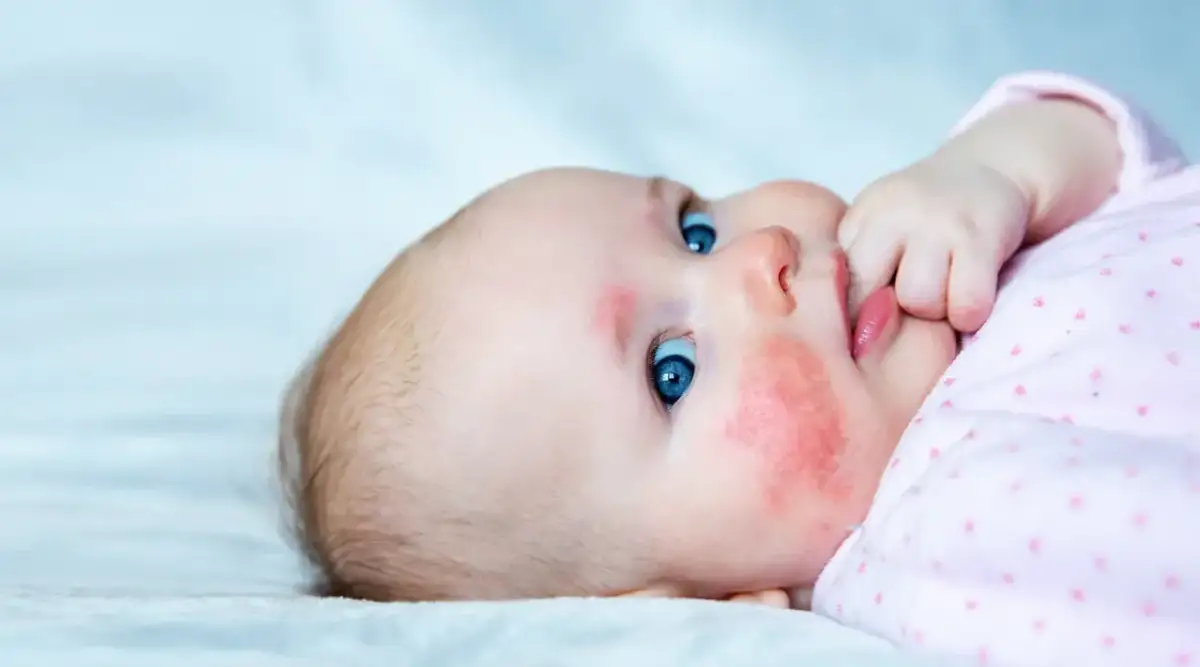 Wysypka u niemowlaka: Skaza białkowa czy potówki? Kluczowe różnice