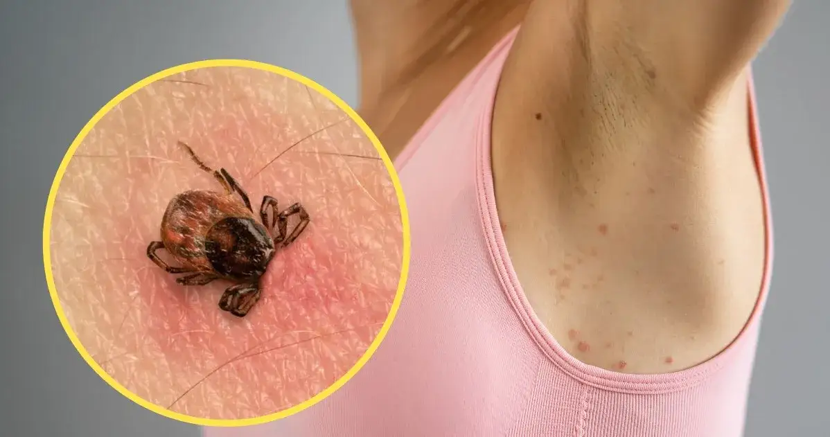 Gdzie siedzą kleszcze i jak ich unikać w popularnych miejscach