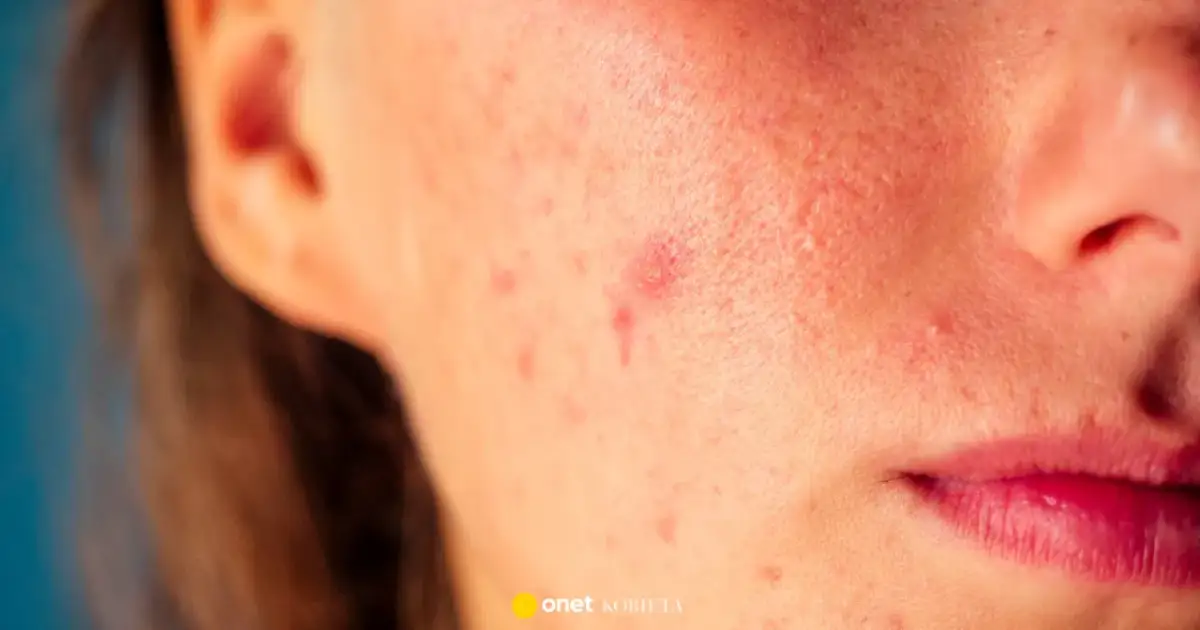 Pryszcz pękł? Goj ranę szybko i bez śladów porady eksperta