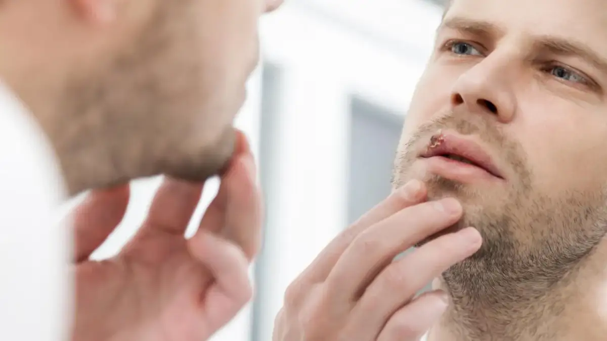 Opryszczka a dentysta: Kiedy wizyta jest bezpieczna i dlaczego?