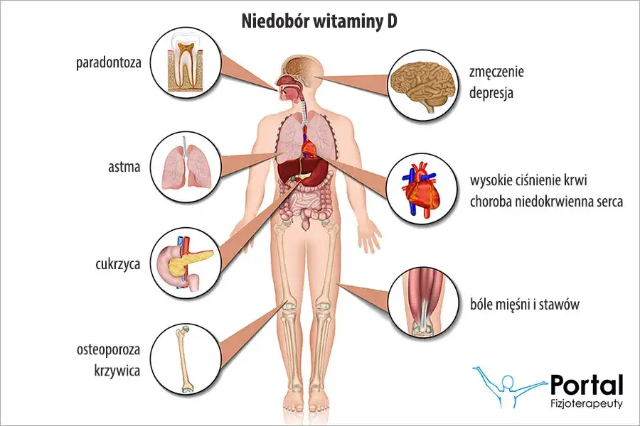 Niedobór witaminy D: 20 objawów, których nie wolno ignorować!