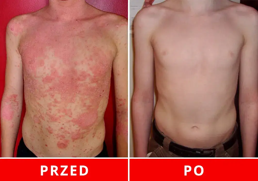 Łuszczyca: Metody leczenia w Polsce od maści po terapie biologiczne
