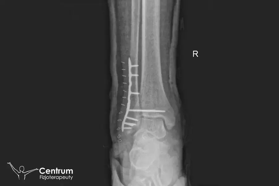 Złamanie kostki bocznej: ile trwa rehabilitacja? Twój plan krok po kroku