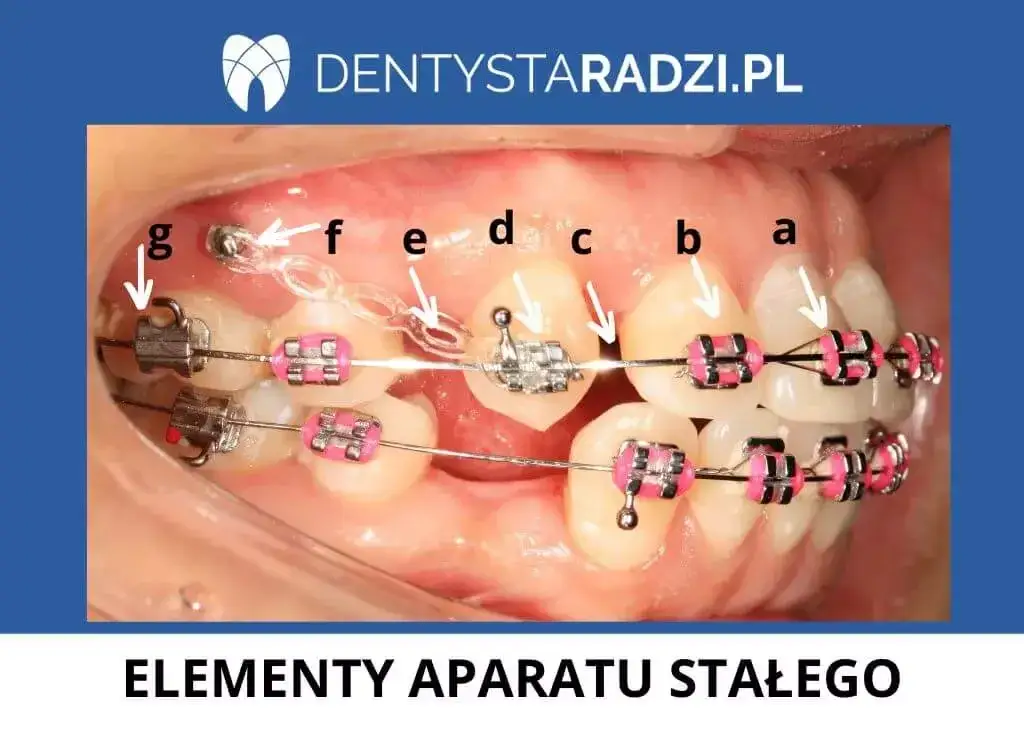 Stały aparat na zęby: budowa, rodzaje i wygląd. Wybierz swój!