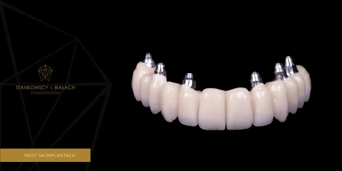 Wstawienie zęba: Implant, most, proteza? Poznaj koszty i wybierz!