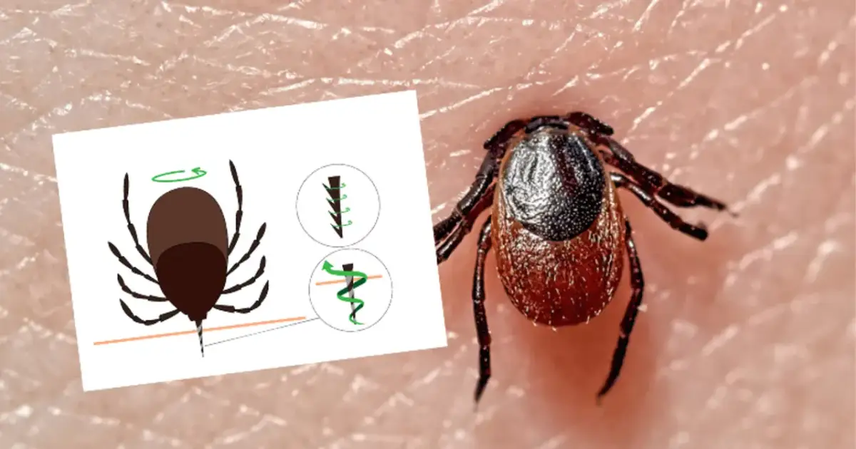 Jak bezpiecznie usunąć kleszcza? Kierunek nie ma znaczenia!