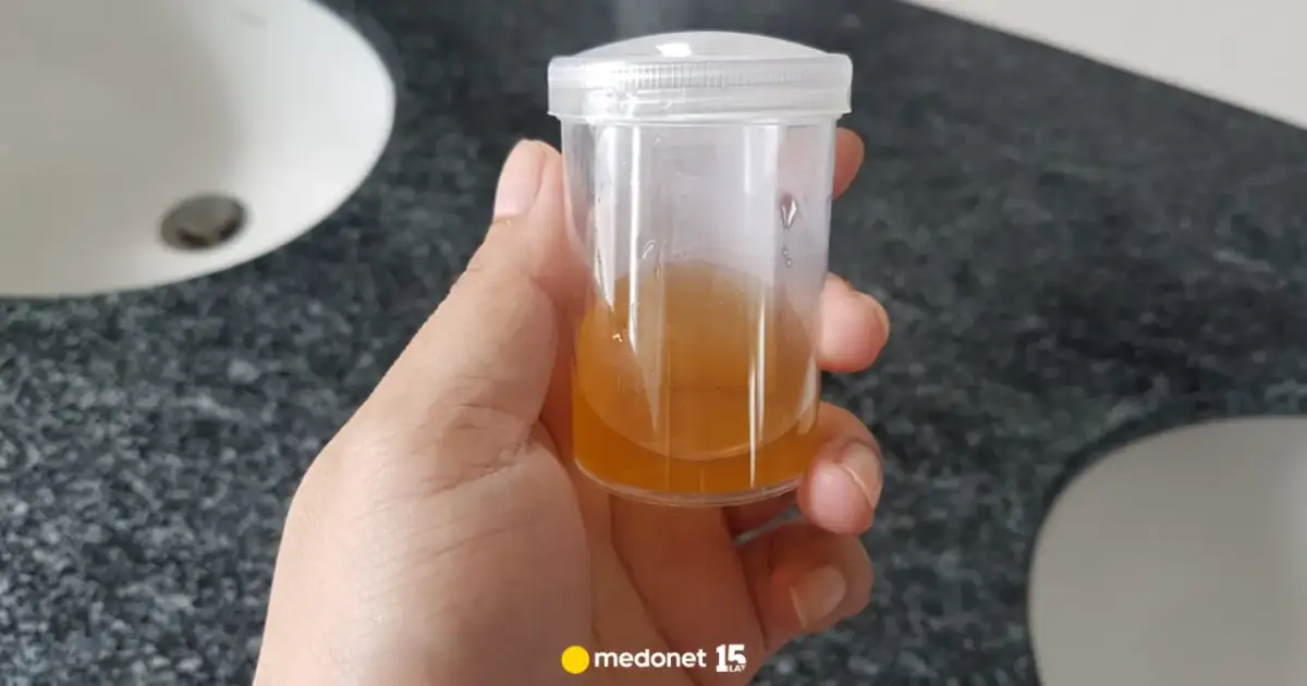 Ciemny mocz i jasny stolec: Co oznacza ten sygnał? Kiedy do lekarza?