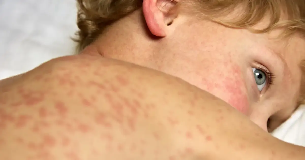 Skóra dziecka pokryta czerwonymi plamkami – czy to różyczka czy uczulenie? Widać zaczerwienione policzki i kark.