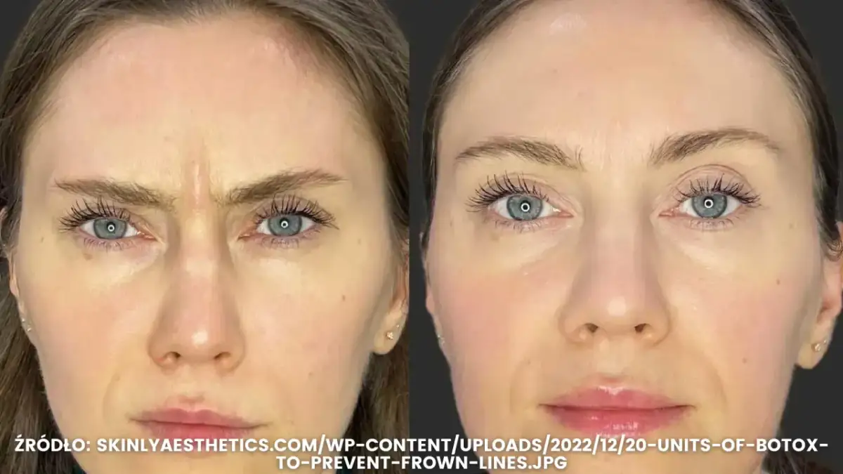 Lwia zmarszczka: botoks kiedy efekty i jak długo się utrzymają?