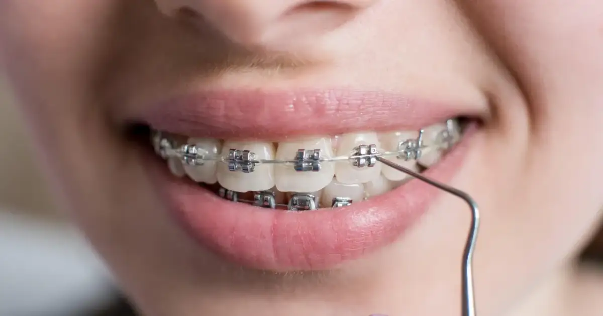 Czy potrzebujesz aparatu na zęby? Sprawdź objawy i wady zgryzu.