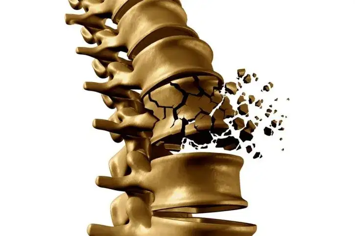 Kompresyjne złamanie kręgosłupa: Ćwicz bezpiecznie, unikaj błędów