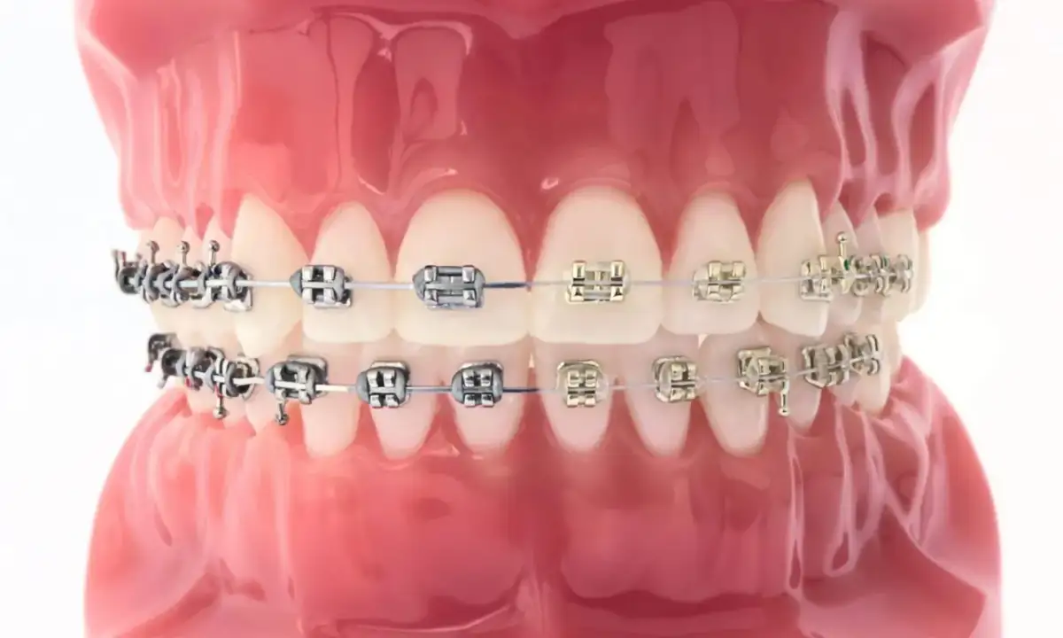 Model szczęki z aparatem ortodontycznym na zębach.