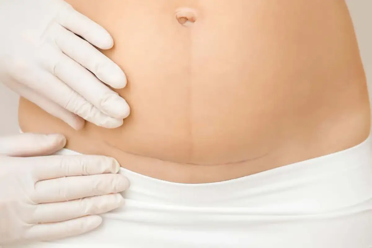 Delikatne badanie blizny po cc. Fizjoterapia po cc pomaga w powrocie do formy.