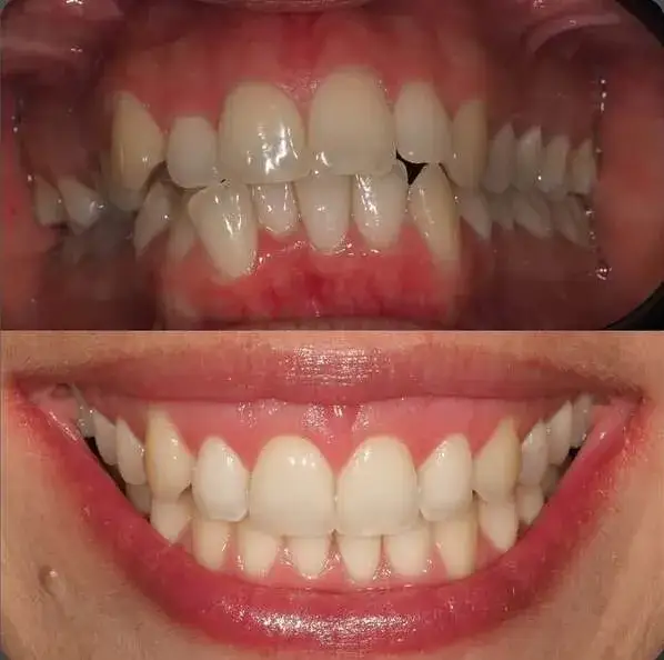 Aparaty na zęby: Zobacz, jak wyglądają i rozwiej obawy!