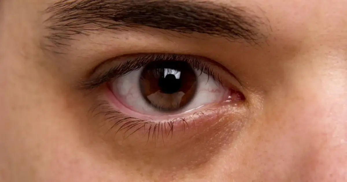 Co mówią sińce pod oczami? Poznaj przyczyny i sygnały!