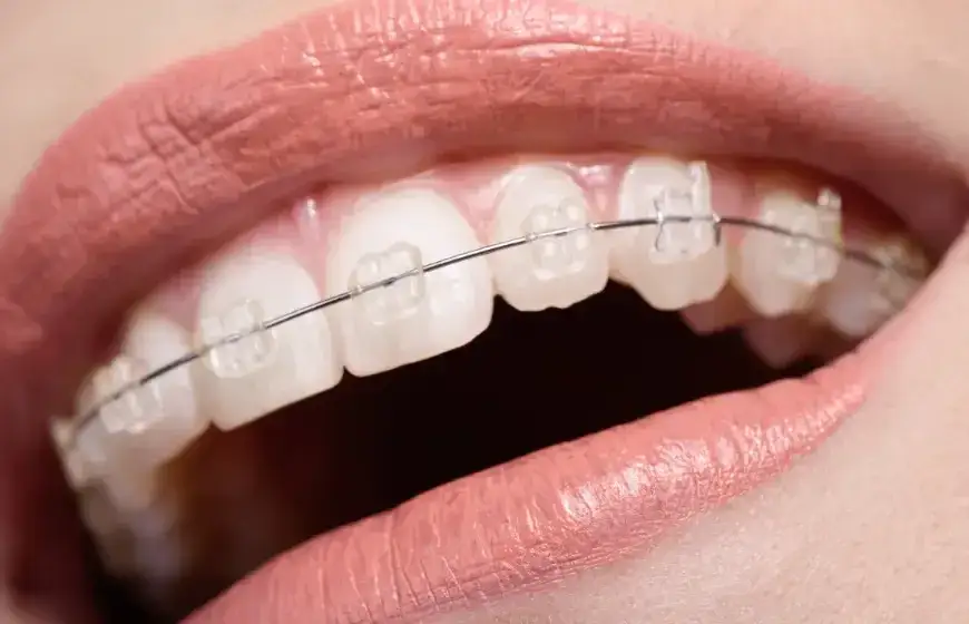 Ile kosztuje aparat? Przewodnik po cenach, typach i wyborze