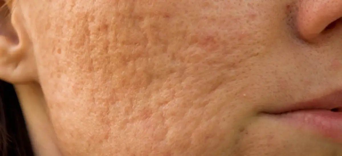 Strup po pryszczu? Pozbądź się go szybko i bez blizn!