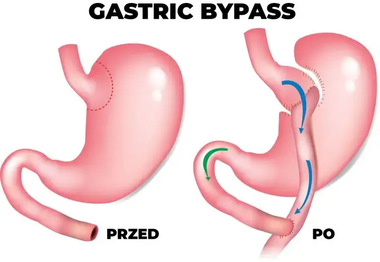 Operacja zmniejszenia żołądka nfz gdzie - sprawdź najlepsze ośrodki