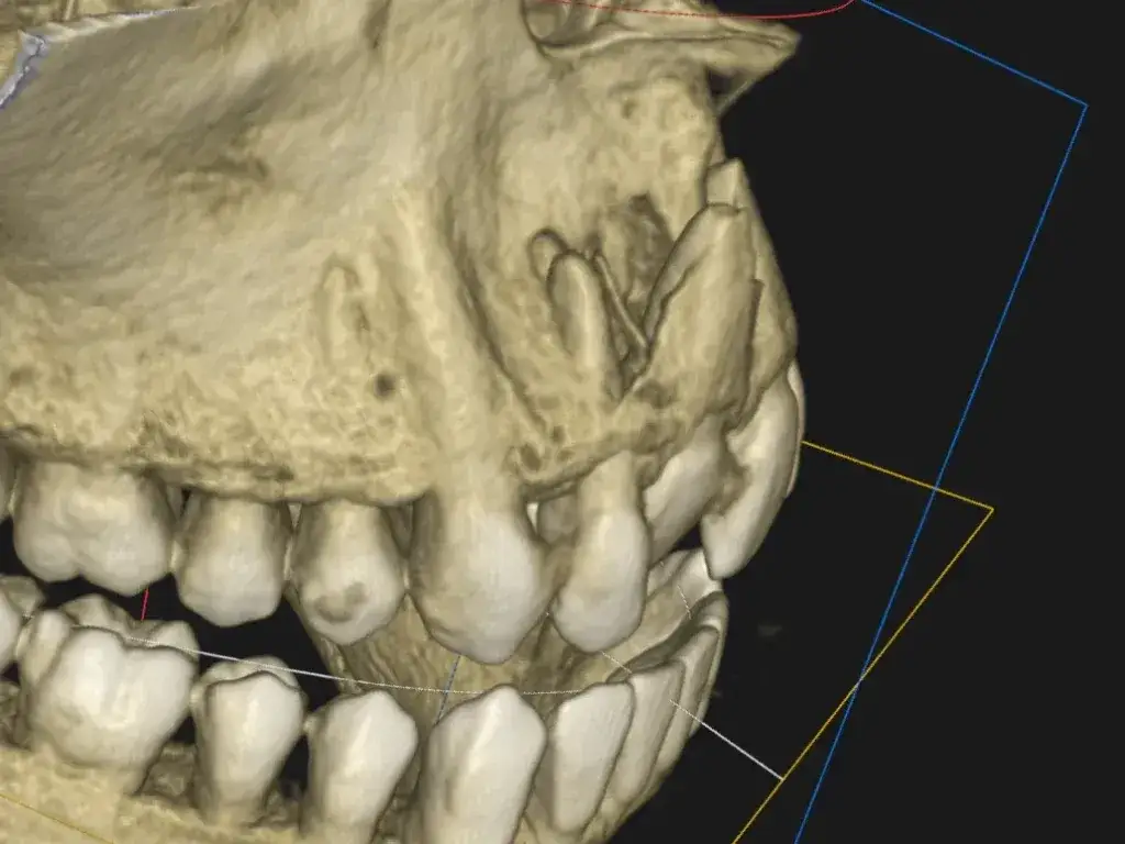 Połknięcie zęba przez dziecko: Bez paniki! Poradnik dla rodziców