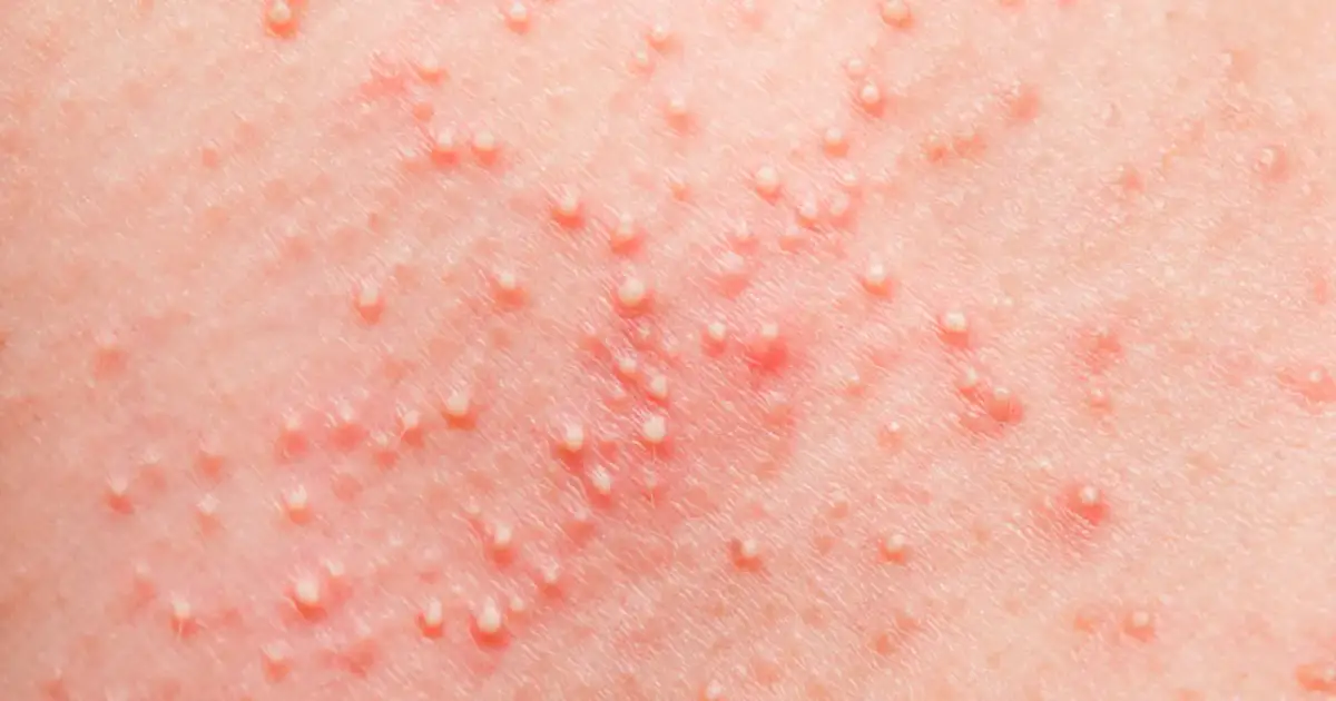 Potówki u niemowlaka: co działa? Sprawdzone porady rodziców i ekspertów