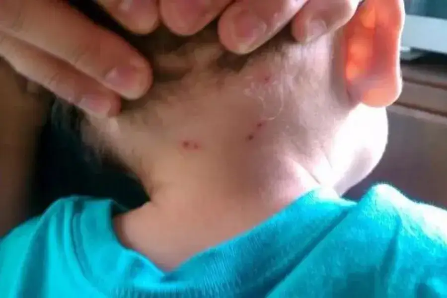 Cómo evitar las picaduras de pulgas en humanos y sus efectos dañinos