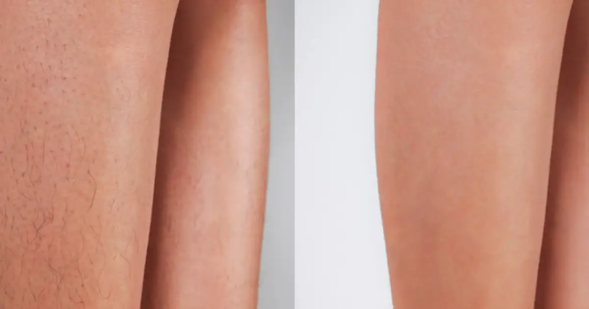 Ile trwa depilacja laserowa? Cały proces od A do Z