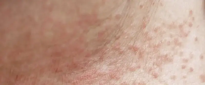 Jak rozpoznać potówki u niemowlaka - objawy i skuteczne leczenie