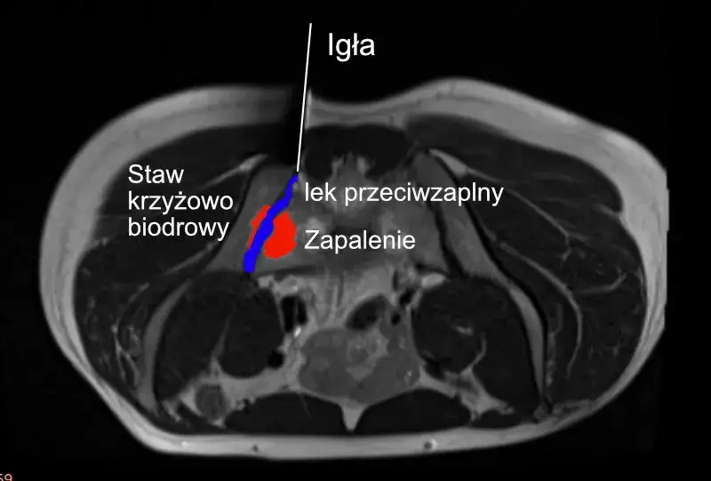 Leczenie zapalenia stawu krzyżowo-biodrowego: od leków po terapie