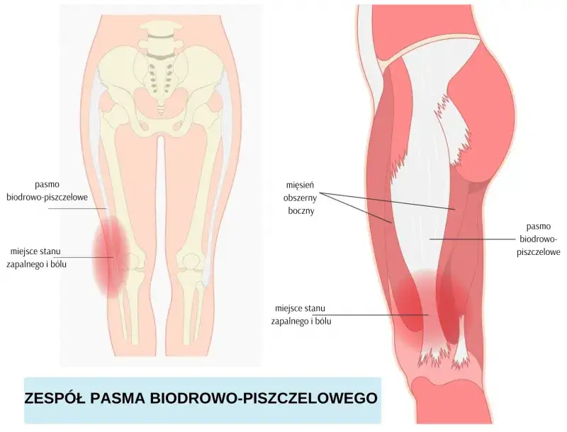 Jak długo trwa ból kolana po bieganiu i co go powoduje?