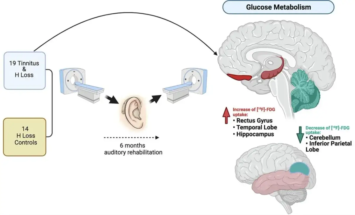 Szumy uszne: Czy piszczenie w głowie jest groźne? Jak sobie radzić?