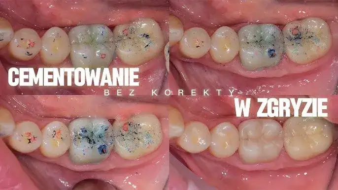 Jak stosować cement NoMIX, aby uniknąć nieprzyjemnych sytuacji z koronami dentystycznymi