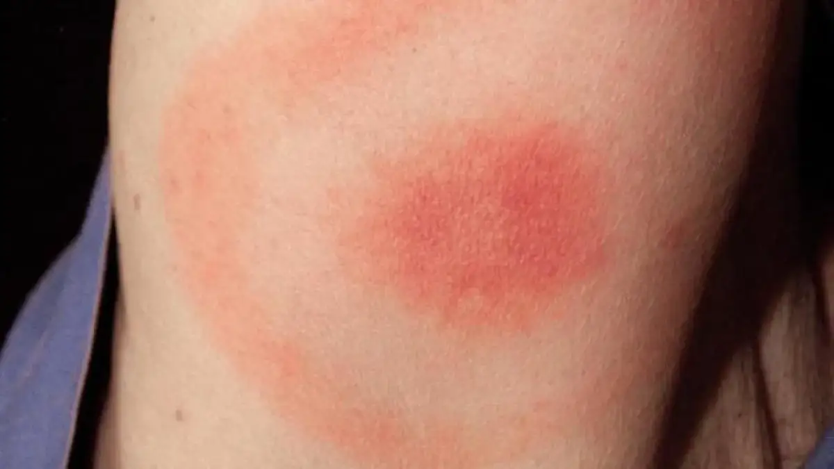 Qué pasa si te pica una garrapata: riesgos y cómo actuar rápidamente