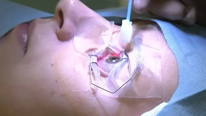 Na czym polega korekcja wzroku? Poznaj metody i korzyści zabiegu