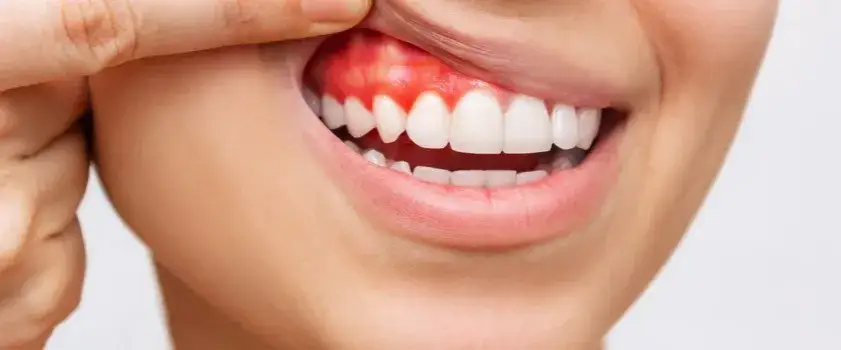 Bolące dziąsło: natychmiastowa ulga i kiedy iść do dentysty?