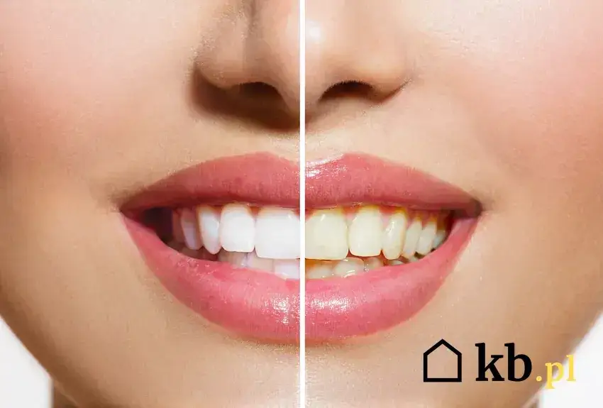 Ile kosztuje wybielanie zębów? Cennik, metody, ukryte koszty