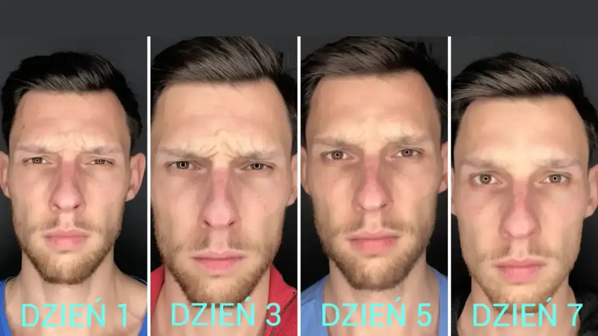 Postęp leczenia bruksizmu botoksem: od dnia 1 do dnia 7. Zmarszczki na czole stają się mniej widoczne.