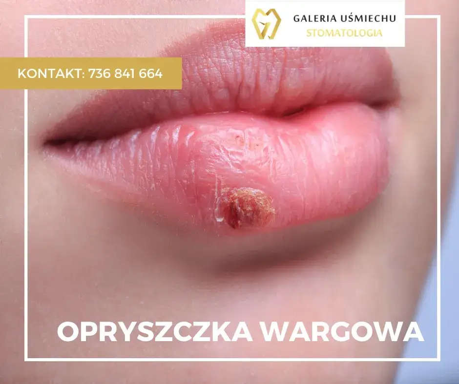 Wizyta u dentysty z opryszczką? Kiedy jest bezpieczna i co robić?